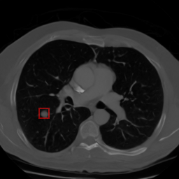 Synthetic lung nodules generated in chest CT scans