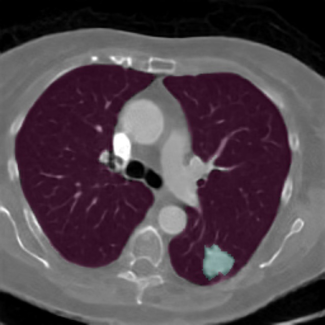 Synthetic chest CT volume generated with the LAND model